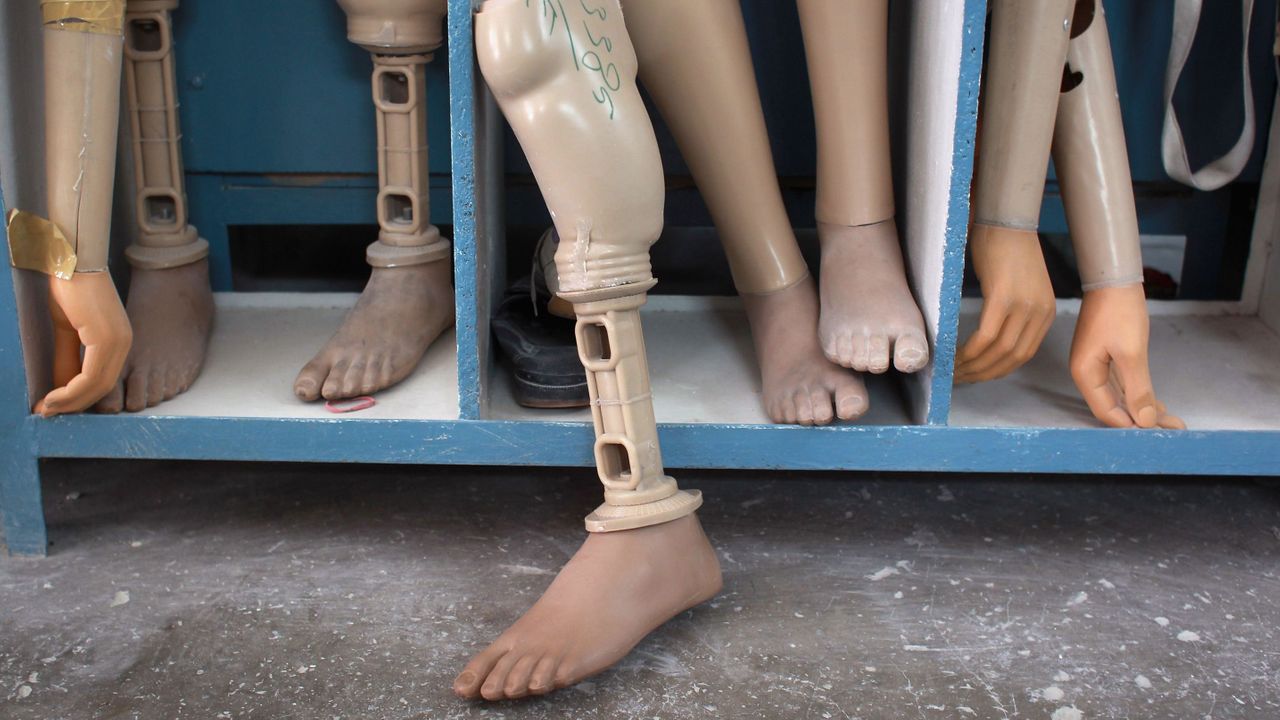 New amputation surgery makes prosthetic foot feel like the real thing