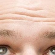 Clue to male baldness discovered thumbnail