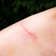 Why scar tissue looks and feels weird thumbnail