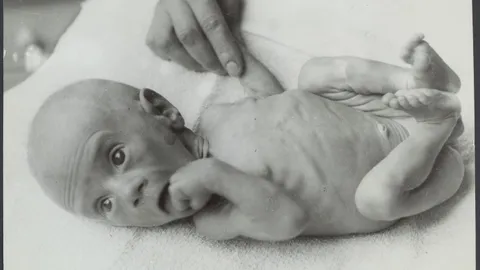 The legacy of poor nutrition