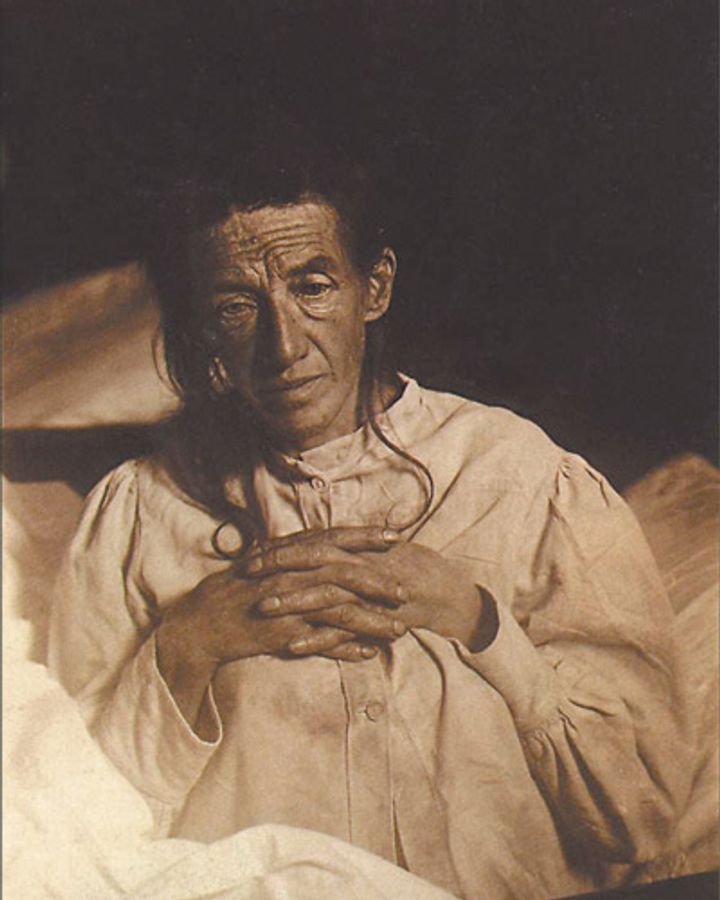 In the early 1900s, Auguste Deter was the first person to be diagnosed with Alzheimer's (Credit: Wikipedia)