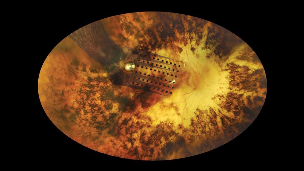 An implanted electrode on the retina bypasses the failed parts of the eye (Second Site) An implanted electrode on the retina bypasses the failed parts of the eye (Second Site)