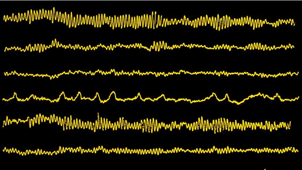 Suppression of the brain's alpha waves may partly help explain the condition (Credit: SPL)