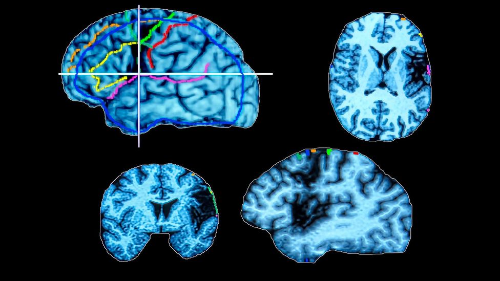 Computed tomography (CT) scans show brain activity in the cortical and subcortical areas, activated during the recognition of faces and objects (Credit: Science Photo Library) Computed tomography (CT) scans show brain activity in the cortical and subcortical areas, activated during the recognition of faces and objects (Credit: Science Photo Library)