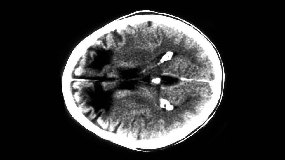 A lobotomy involves drilling through the skull and using needles to damage the frontal lobes (dark regions) (Credit: SPL)