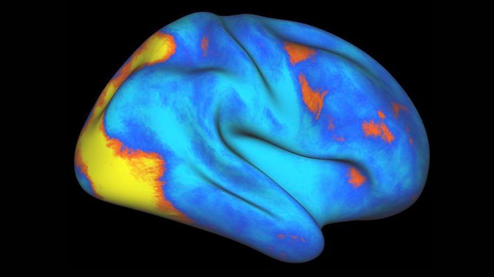 Increases (orange-yellow) and decreases (blue) of neural activity in the human brain (Credit: Gaurav Patel/Columbia University Medical Center) Increases (orange-yellow) and decreases (blue) of neural activity in the human brain (Credit: Gaurav Patel/Columbia University Medical Center)
