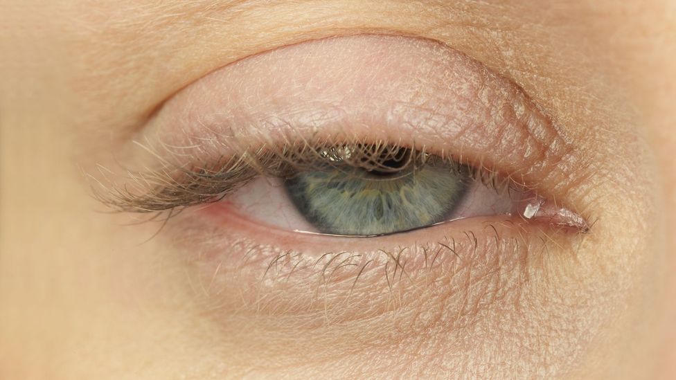 What Causes Bags under Eyes After Sleeping 