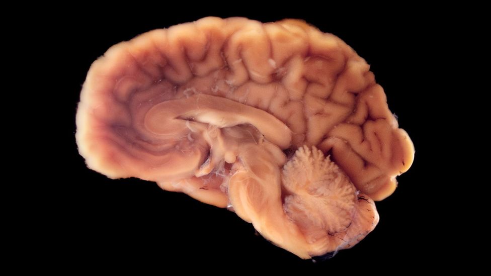 The brain uses up 25% of our body's oxygen, meaning it is the first organ to die after we stop breathing (Credit: Getty Images)