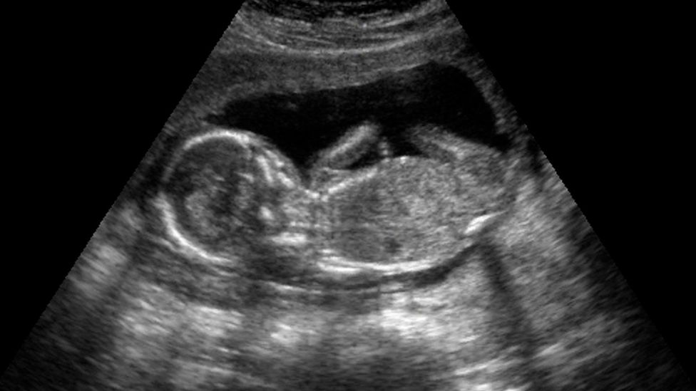 A beating heart cadaver may still be able to sustain a growing foetus (Credit: Science Photo Library)