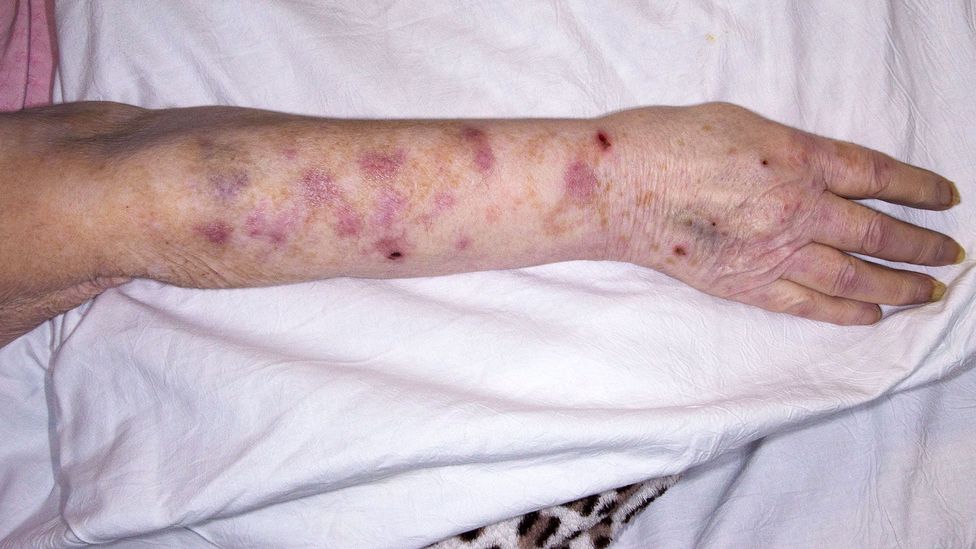 The burning pain that occurs with an outbreak of shingles can be unbearable (Credit: Mid Essex Hospital Services NHS Trust/Science Photo Library) The burning pain that occurs with an outbreak of shingles can be unbearable (Credit: Mid Essex Hospital Services NHS Trust/Science Photo Library)