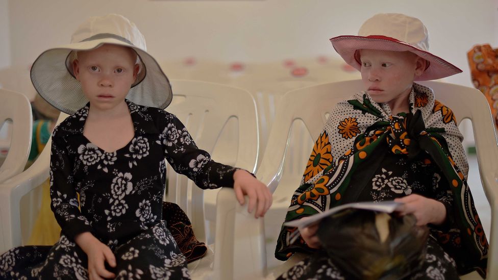 Children with albinism need to wear hats and long sleeves to protect them from the harmful rays of the Sun (Credit: Carl de Souza/AFP/Getty Images)