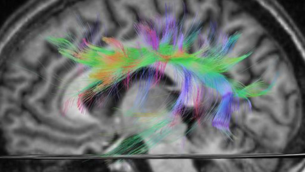 An MRI scan highlighting the language tract in the brain (Credit: Alamy)