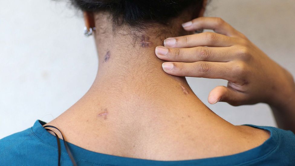 Knife attack survivor Samar Haroun shows the scars that remain on the back of her neck in 2013 (Credit: Getty Images)