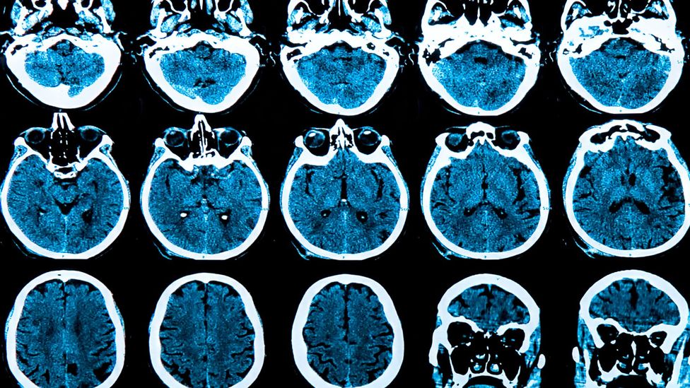 The signs of alzheimer's disease can be spotted in brain scans by artificial intelligence years before diagnosis (Credit: Getty Images)