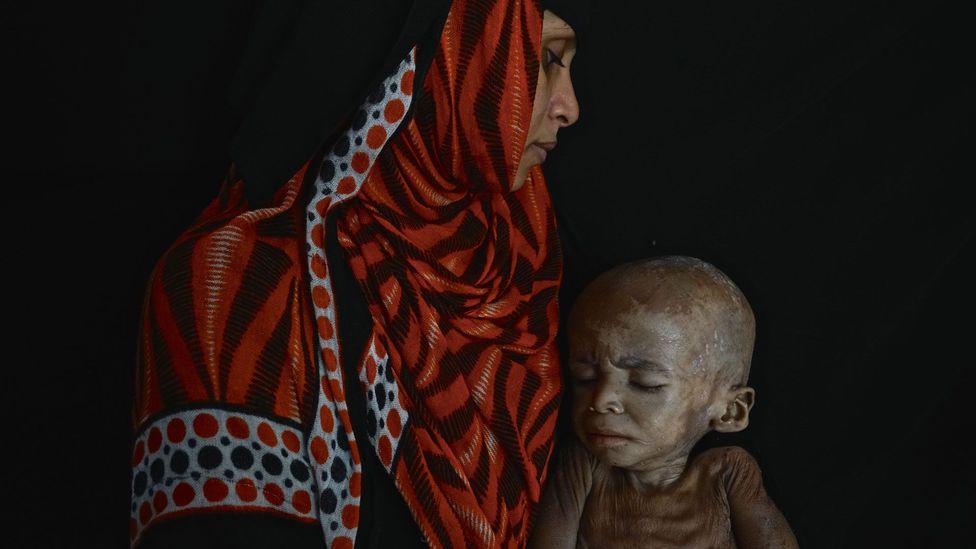 While images of malnourished Ethiopian children featured heavily in the news during the 1980s, victims of famine in Yemen have largely been ignored (Credit: Getty Images)