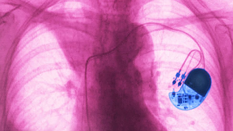 With the help of artificial intelligence, there are hopes that the lifesaving pacemaker could do far more than simply keep your heart beating correctly (Credit: Getty Images)