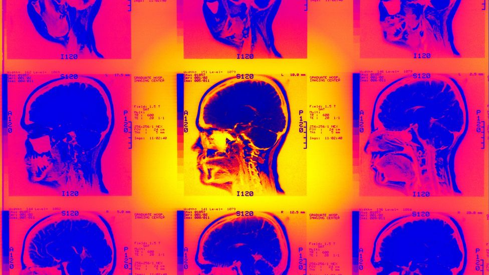 Blows to head can lead neural tissue to swell and reduce the flow of blood to the brain (Credit: Alamy) Blows to head can lead neural tissue to swell and reduce the flow of blood to the brain (Credit: Alamy)