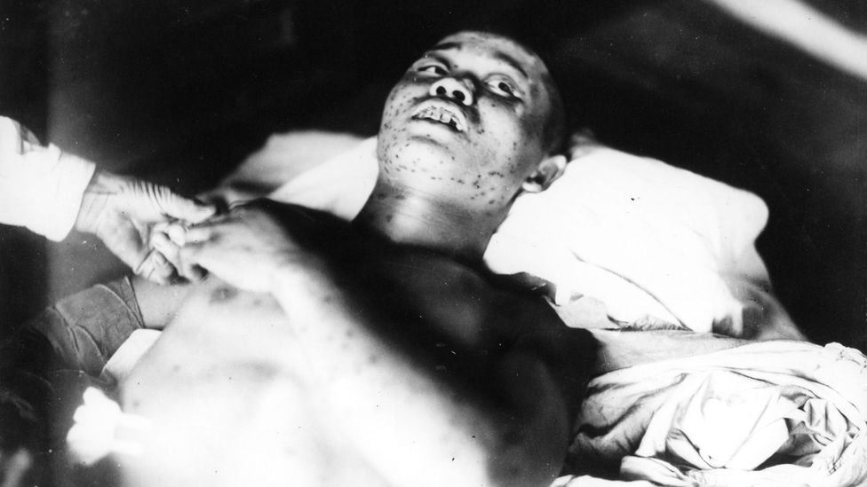 An injured 21-year-old soldier who was exposed to the bombing with subcutaneous haemorrhage spots on his body (Credit: Gonichi Kimura/Hiroshima Peace Memorial Museum/Reuters)