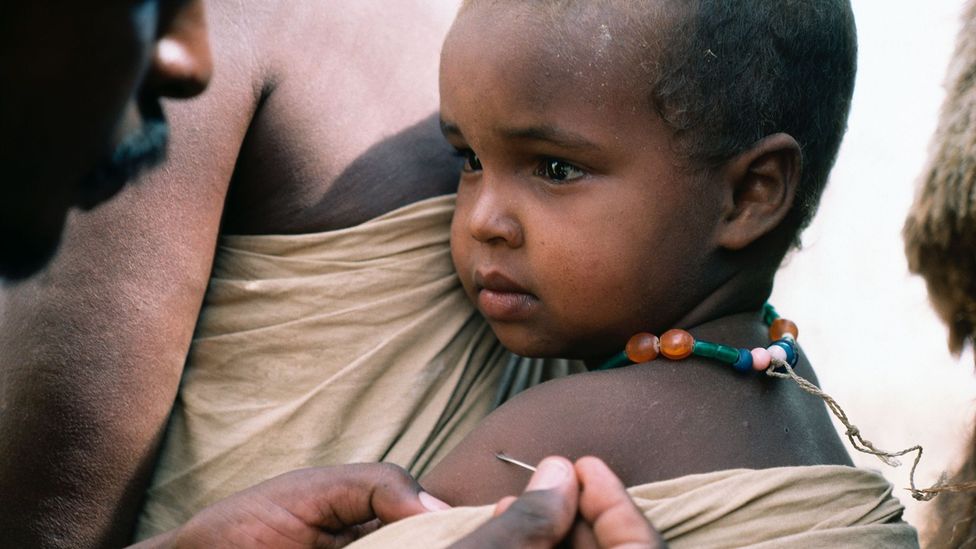A global vaccination programme pushed smallpox into extinction in the wild, although the virus still exists in two secure laboratories (Credit: Alamy)