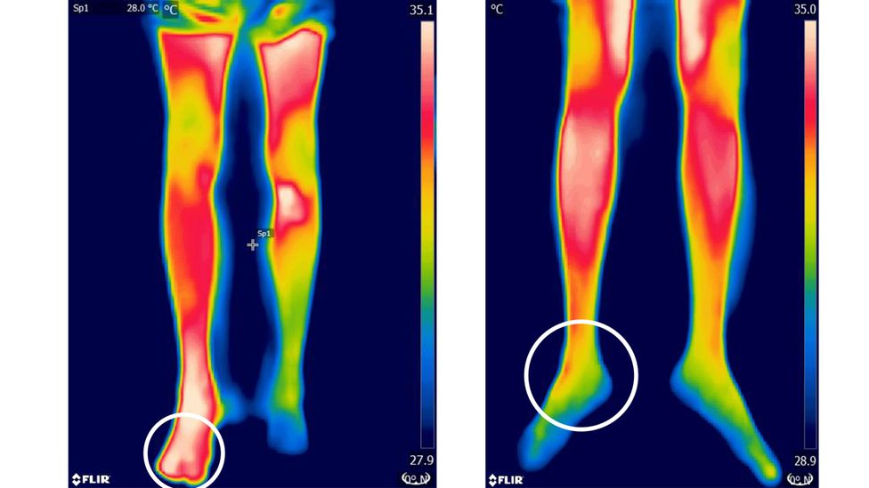 Inflammation caused by snake venom in a bite glows as hot spots on an infrared camera (left) compared to those without venom (Credit: P. Sabitha et al/Plos NTD)