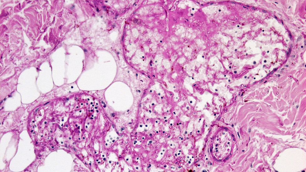 The fungi that cause mucormycosis are found normally in soil and on rotting organic material but can infect humans when they get a chance (Credit: Science Photo Library)