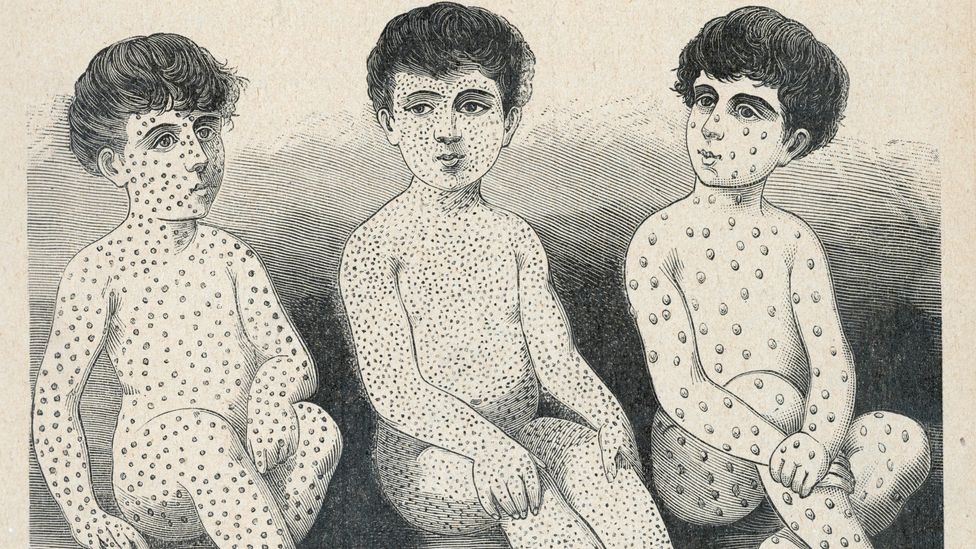 From left-right, drawings of measles, scarlet fever, and smallpox (Credit: Alamy)