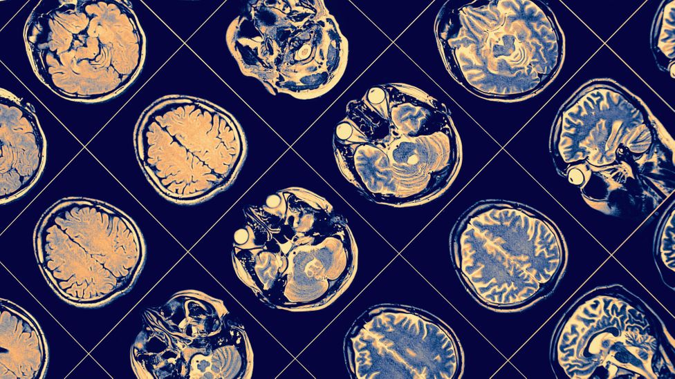MRI image of the brain (Credit: Alamy)