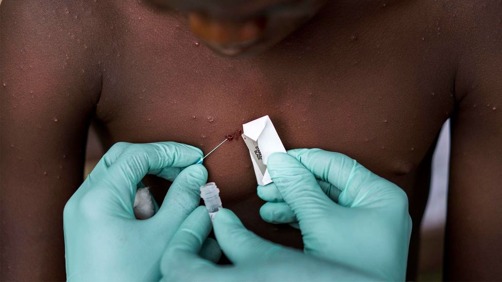 Monkeypox virus has mainly been found in a few African countries, but this year started spreading more globally (Credit: Melina Mara/The Washington Post/Getty Images)
