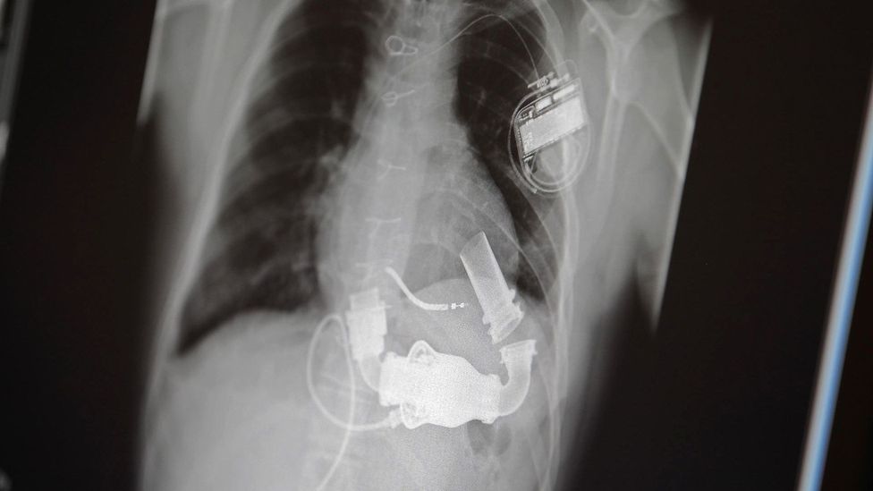 why-science-still-hasn-t-cracked-the-artificial-heart-bbc-future