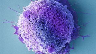Coloured scanning electron micrograph of a prostate cancer cell (Credit: Getty Images)